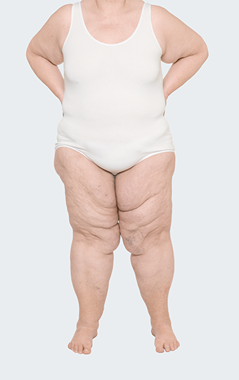 Patientin mit Lipödem Stadium 2