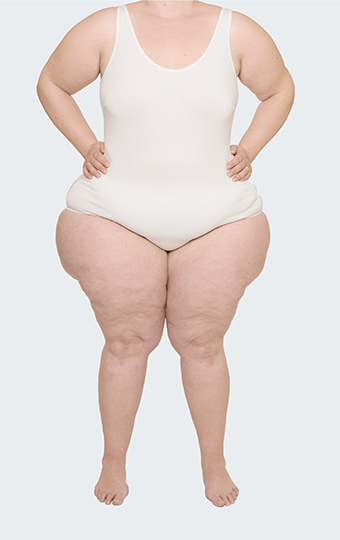 Patientin mit Lipödem Stadium 3