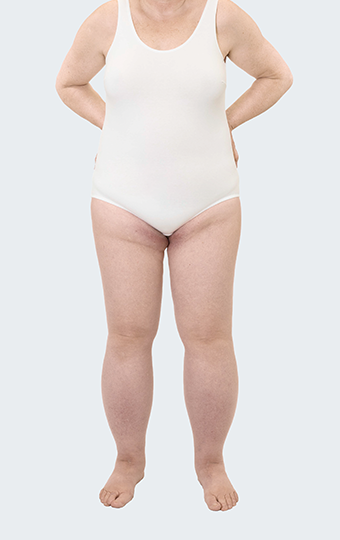 Patientin mit Lymphödem Stadium 1