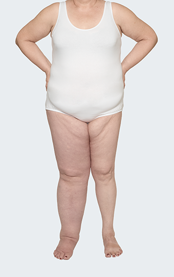 Patientin mit Lymphödem Stadium 2